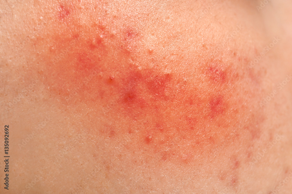 Acne treatment concept. Skin irritation, closeup Acne treatment concept. Skin irritation, closeup