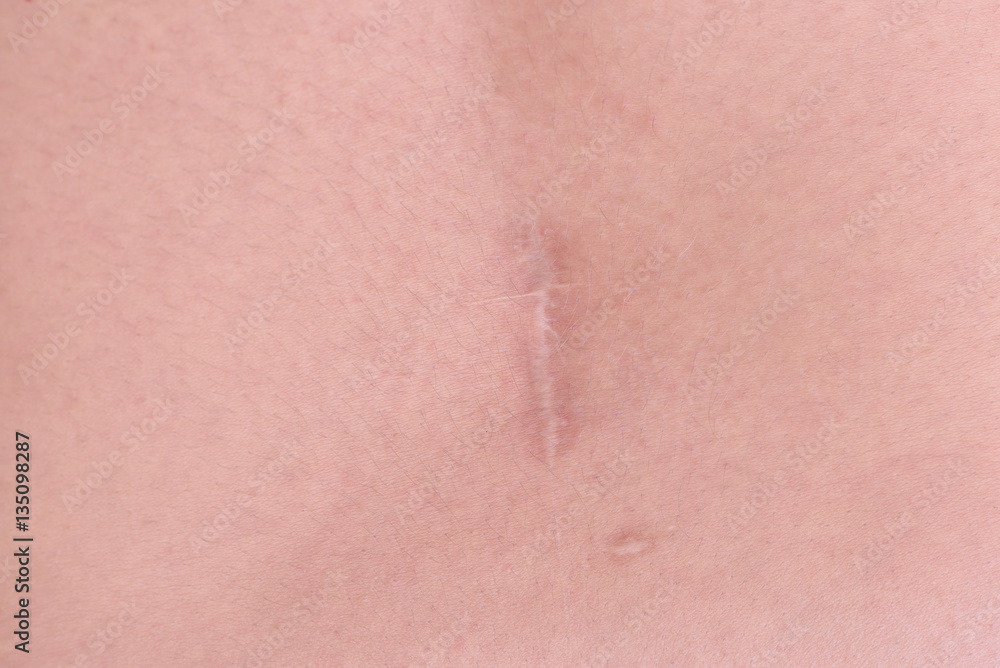Back scar tissue after herniated disc surgery