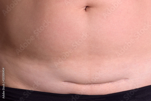 Closeup of woman belly with a scar from a cesarean section