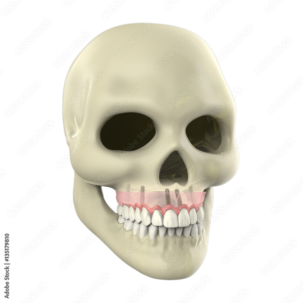 Fototapeta premium 3D rendering implant