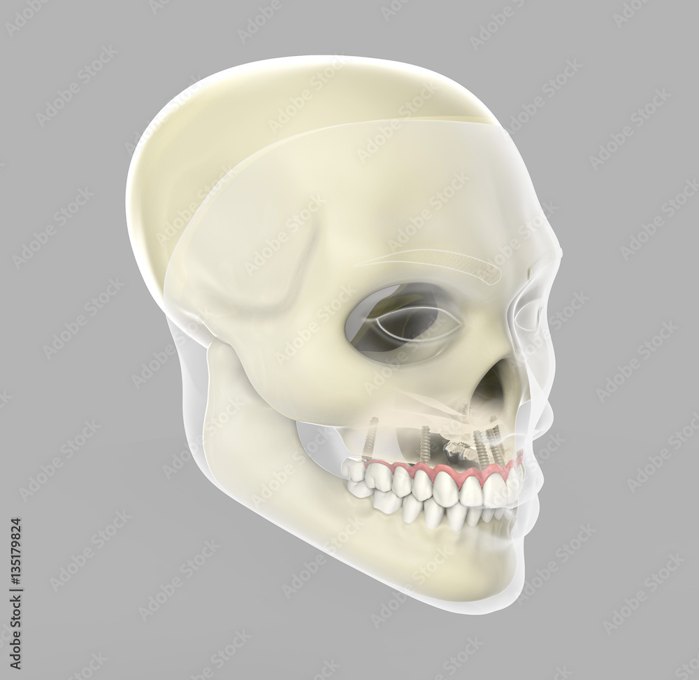 Obraz premium 3D rendering implant