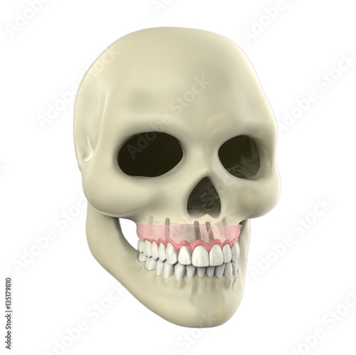 3D rendering implant