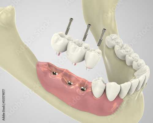 3D rendering implant