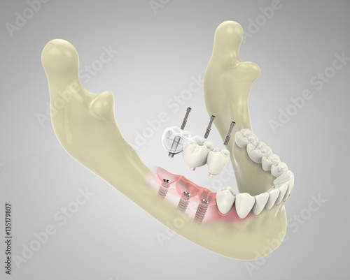 3D rendering implant