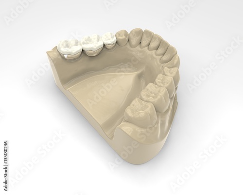 3D rendering dentures