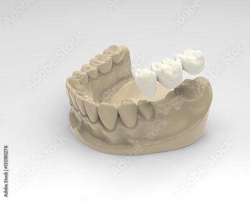 3D rendering dentures