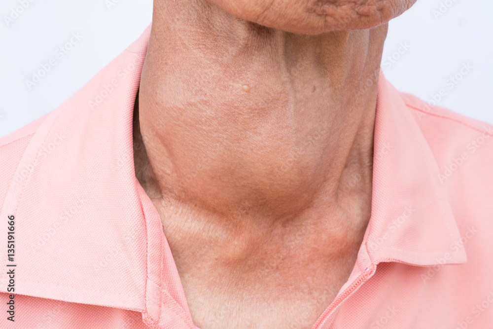 Woman with enlarged hyperthyroid gland. Hyperthyroidism symbol. Woman with enlarged hyperthyroid gland. Hyperthyroidism symbol.