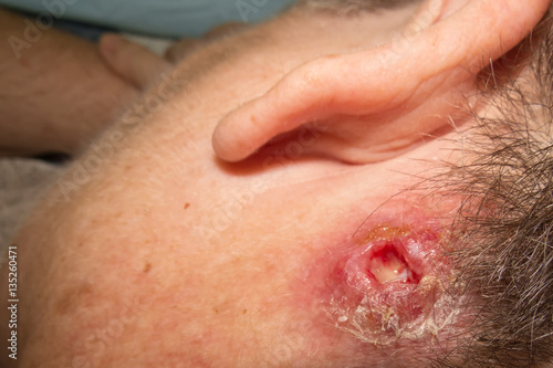 Severe staph infection behind ear of mature woman