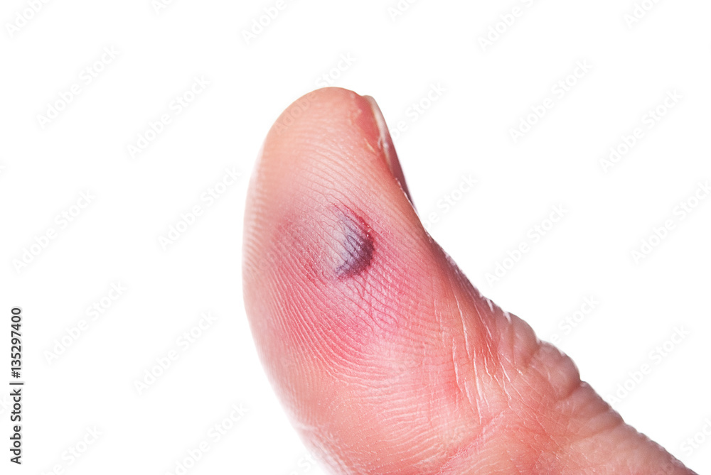 The bruise on finger The bruise on finger
