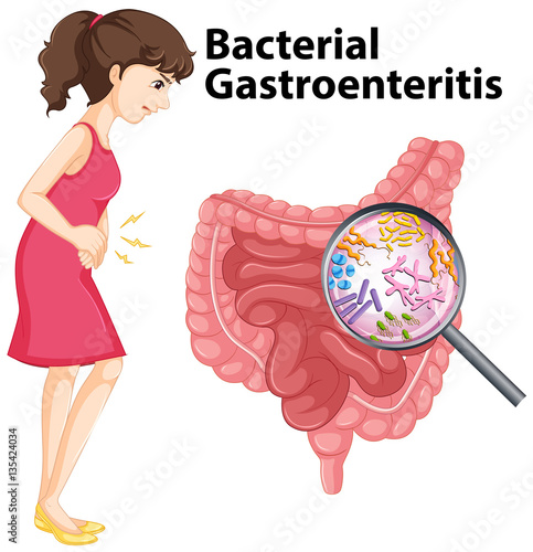 Diagram showing bacterial gastroenteritis in human