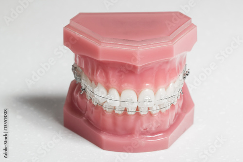 Clear braces - invisible brackets for teeth straightening