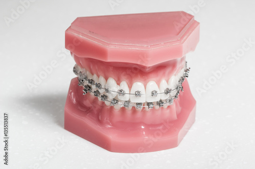 Metal brackets - tooth aligners on a model jaw, white background