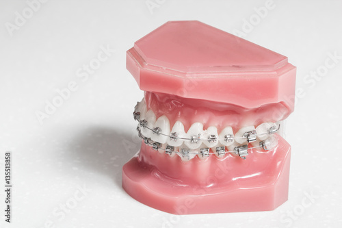 Human jaw model with dental braces
