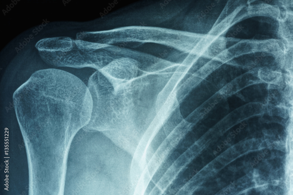 Xray film of primary frozen shoulder or adhesive capsulitis of Asian female patient Stock Photo