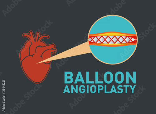 BALLOON ANGIOPLASTY vector icon design