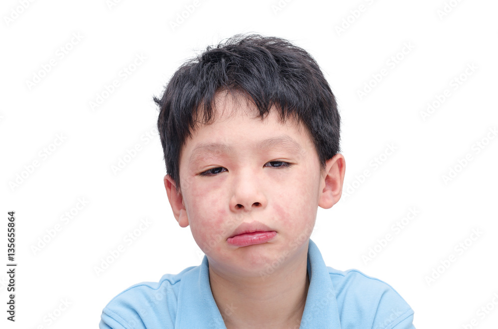 Young asian child face with rash over white background Young asian child face with rash over white background