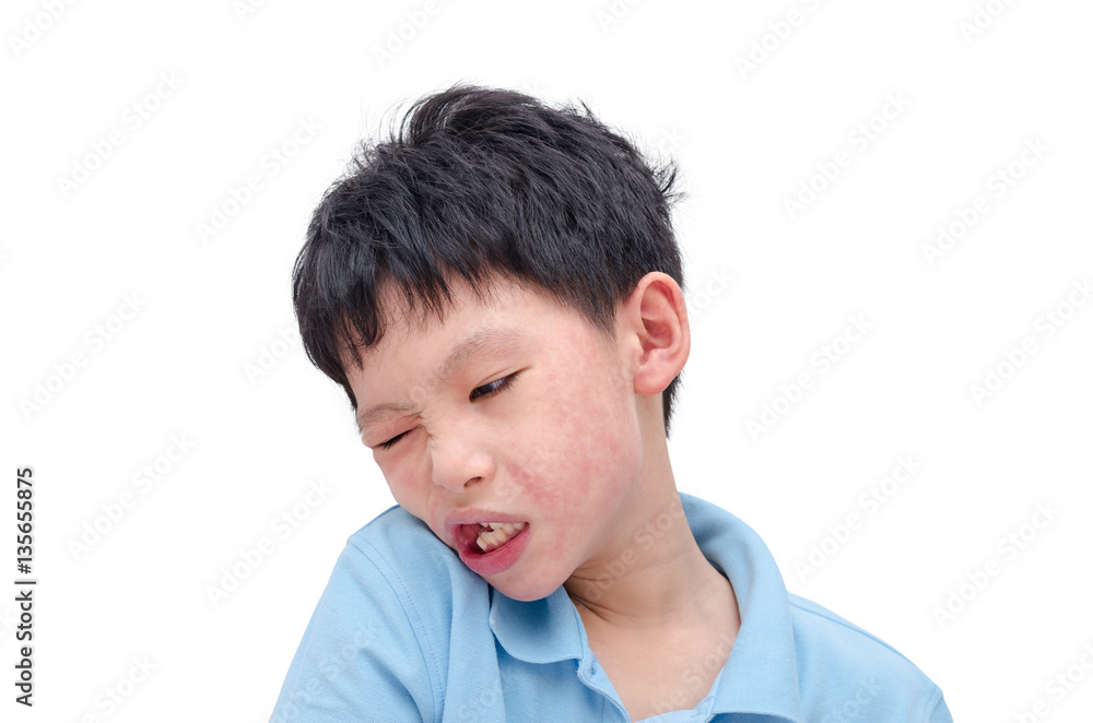 Young asian child face with rash over white background Young asian child face with rash over white background