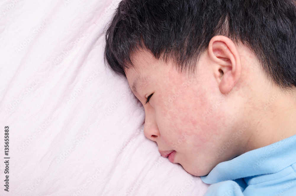 Young asian child face with rash lying on bed - obrazy, fototapety, plakaty 