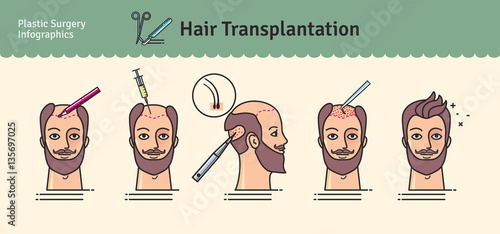Vector Illustrated set with hair transplant surgery