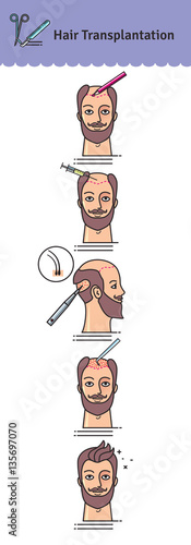 Vector Illustrated set with hair transplant surgery