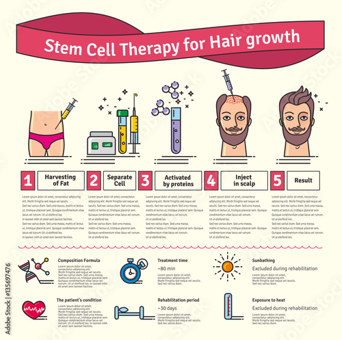 Vector Illustrated set with stem cell therapy for hair growth