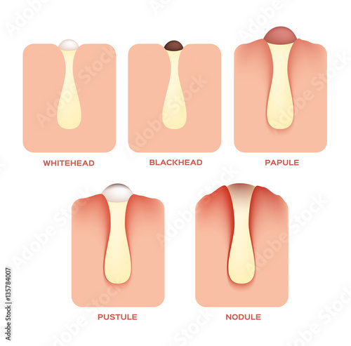Types of Acne and Pimples, stages of development, vector illustration