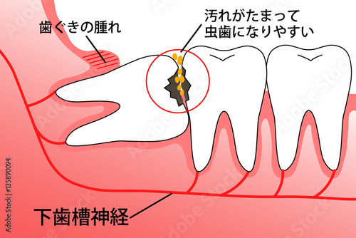 親知らず　埋伏智歯