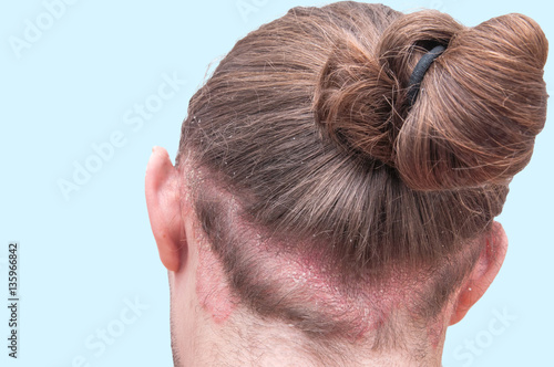 Proven diagnosis of Psoriasis Vulgaris exacerbation on back of man's head and scalp. Red psoraitic spot on hairline. Dermatological disease, stress, seborrhea, dermatitis, appearance, eczema concept