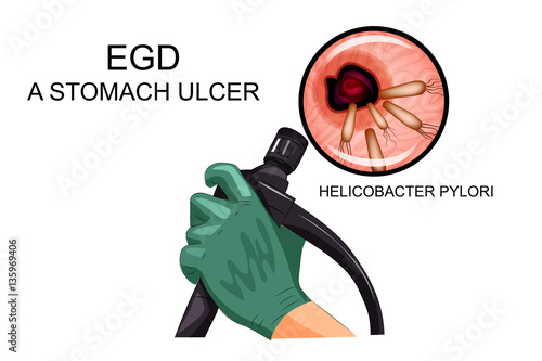 EGD, diagnosis of gastric ulcer photo