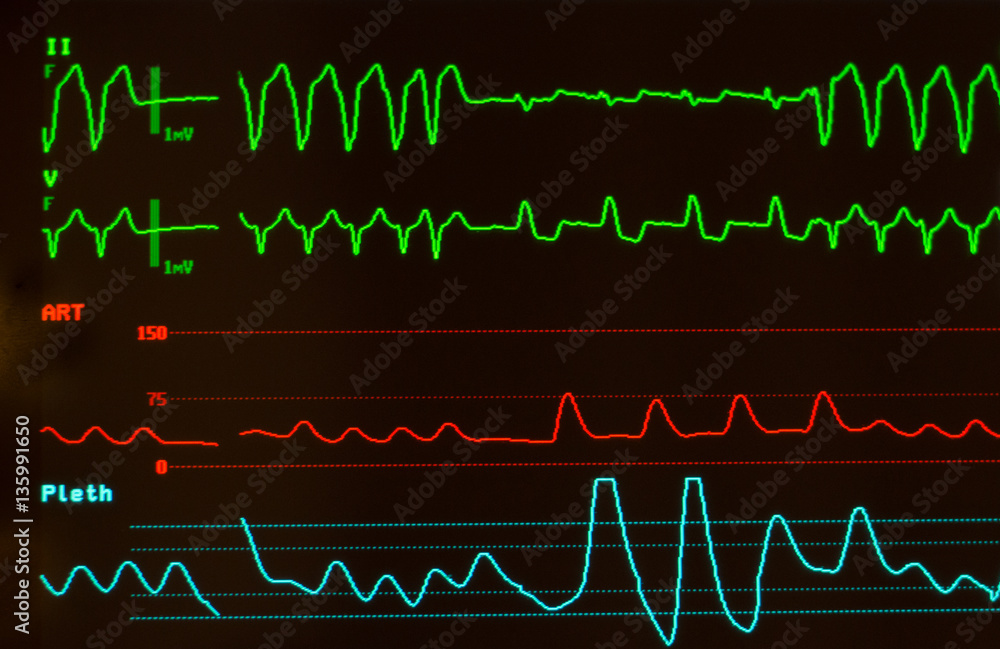 Close up of monitor with black screen showing ventricular tachycardia on ECG on green lines, arterial blood pressure on red line and oxygen saturation on blue line. 