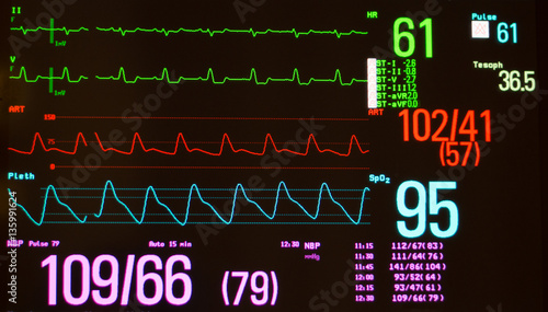 Monitor with black screen showing Intraventricular Conduction Delay on green lines, arterial blood pressure on red line , oxygen saturation on blue line, temperature and noninvasive blood pressure. 