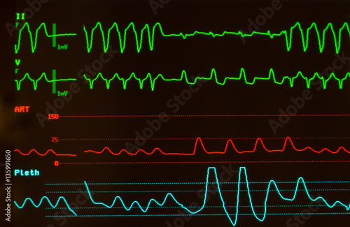 Close up of monitor with black screen showing ventricular tachycardia on ECG on green lines, arterial blood pressure on red line and oxygen saturation on blue line.  photo