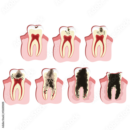 Caries progress illustration: 7 stages