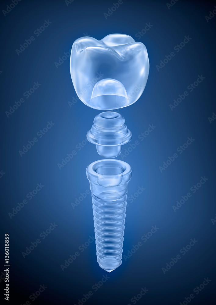 Dental titanium implant, x-ray view Stock Illustration | Adobe Stock