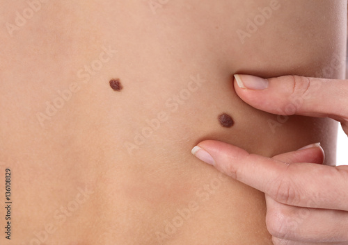 Fotografie Doctor dermatologist examines child patient birthmark close up