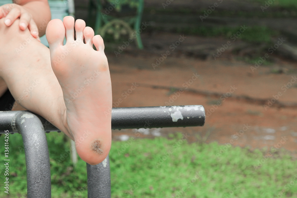 foot corn :Select focus with shallow depth of field. foot corn :Select focus with shallow depth of field.