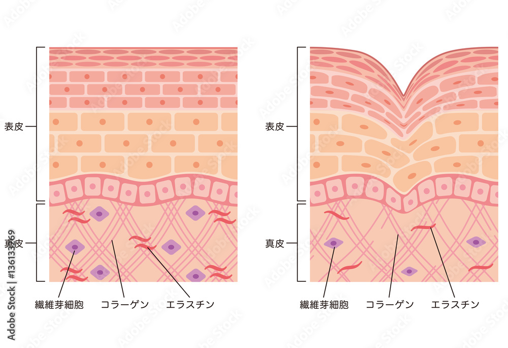 しわ 皮膚の構造 断面図 Stock イラスト Adobe Stock しわ 皮膚の構造 断面図 Stock イラスト Adobe Stock