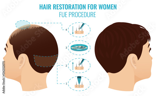 Female hair loss treatment with follicular unit extraction. Stages of FUE procedure for women. Alopecia medical template for transplantation clinics and diagnostic centers. Vector illustration.