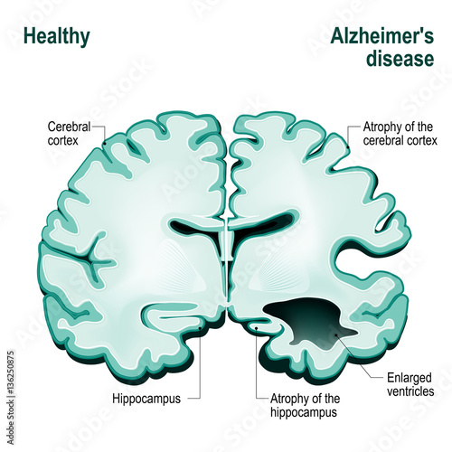 Cross section of the human brain. Alzheimer's disease