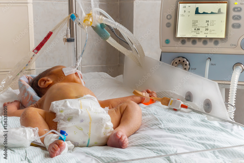 Newborn baby with hyperbilirubinemia on breathing machine with pulse