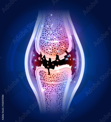 Damaged Synovial joint colorful bright design on an abstract blue background