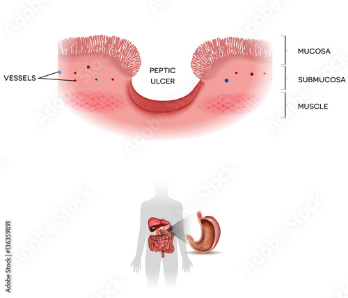 Peptic ulcer of the stomach on a white background, at the bottom human silhouette with gastrointestynal system organs photo