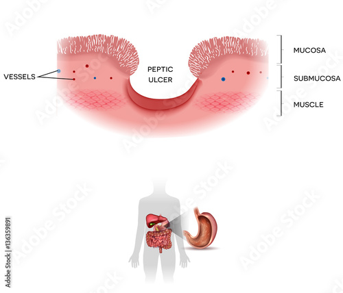 Peptic ulcer of the stomach on a white background, at the bottom human silhouette with gastrointestynal system organs