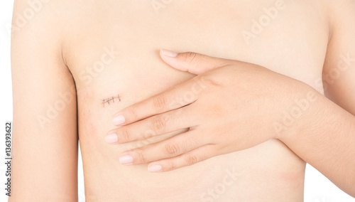 Scars from surgery breast