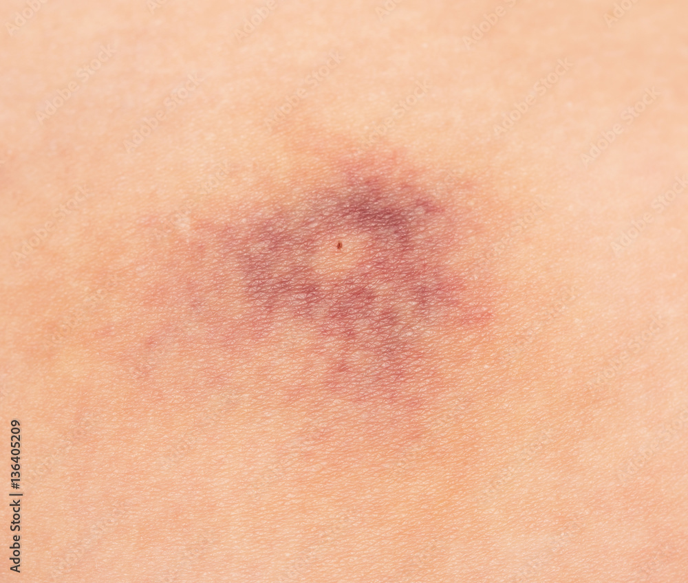 Fototapeta premium a bruise on the skin