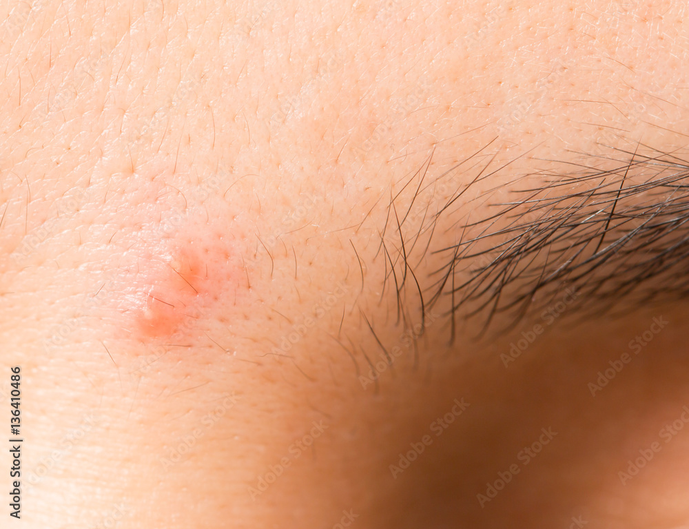 acne on the skin