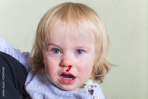 bleeding from the nose child