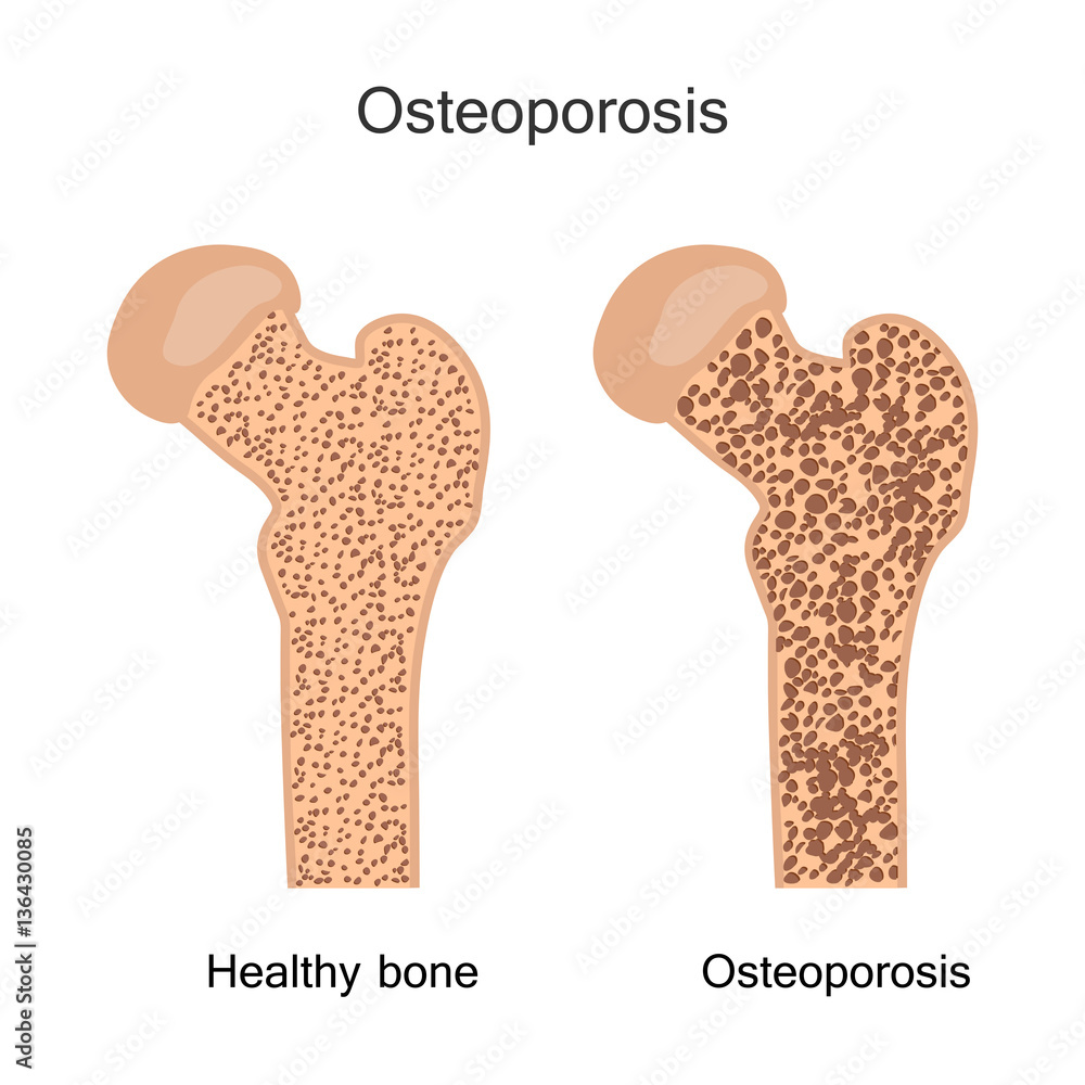 Bone Osteoporosis Illustration Stock Vector | Adobe Stock