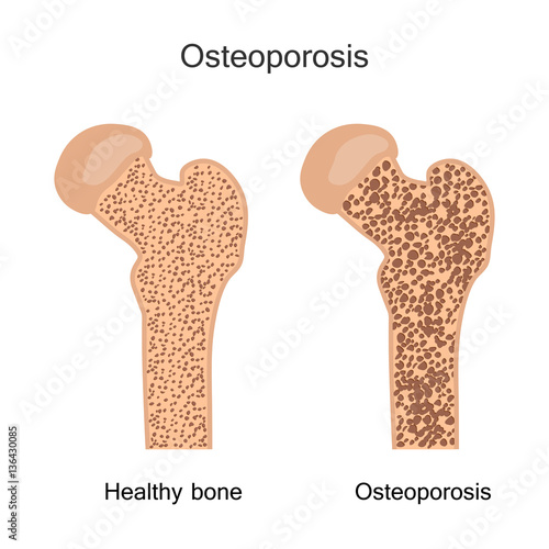 Bone Osteoporosis Illustration