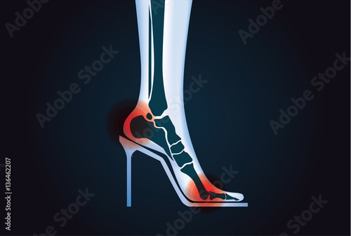 Red signal at foot bone area because wearing high heels. This illustration about health care.